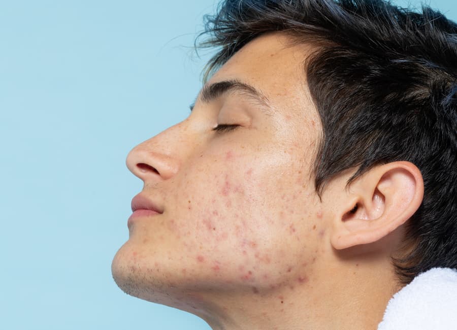 Acne 3